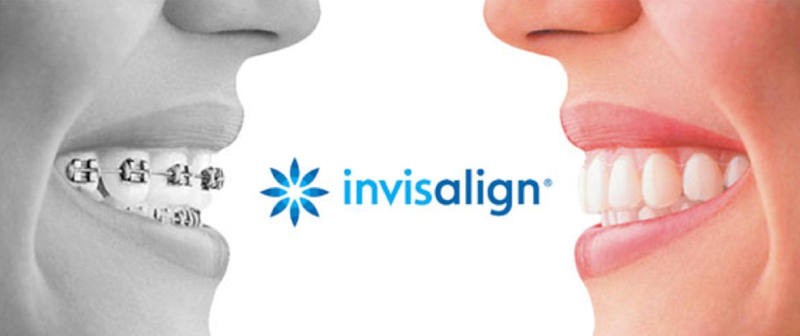 Side-by-side comparison of traditional metal braces and Invisalign clear aligners