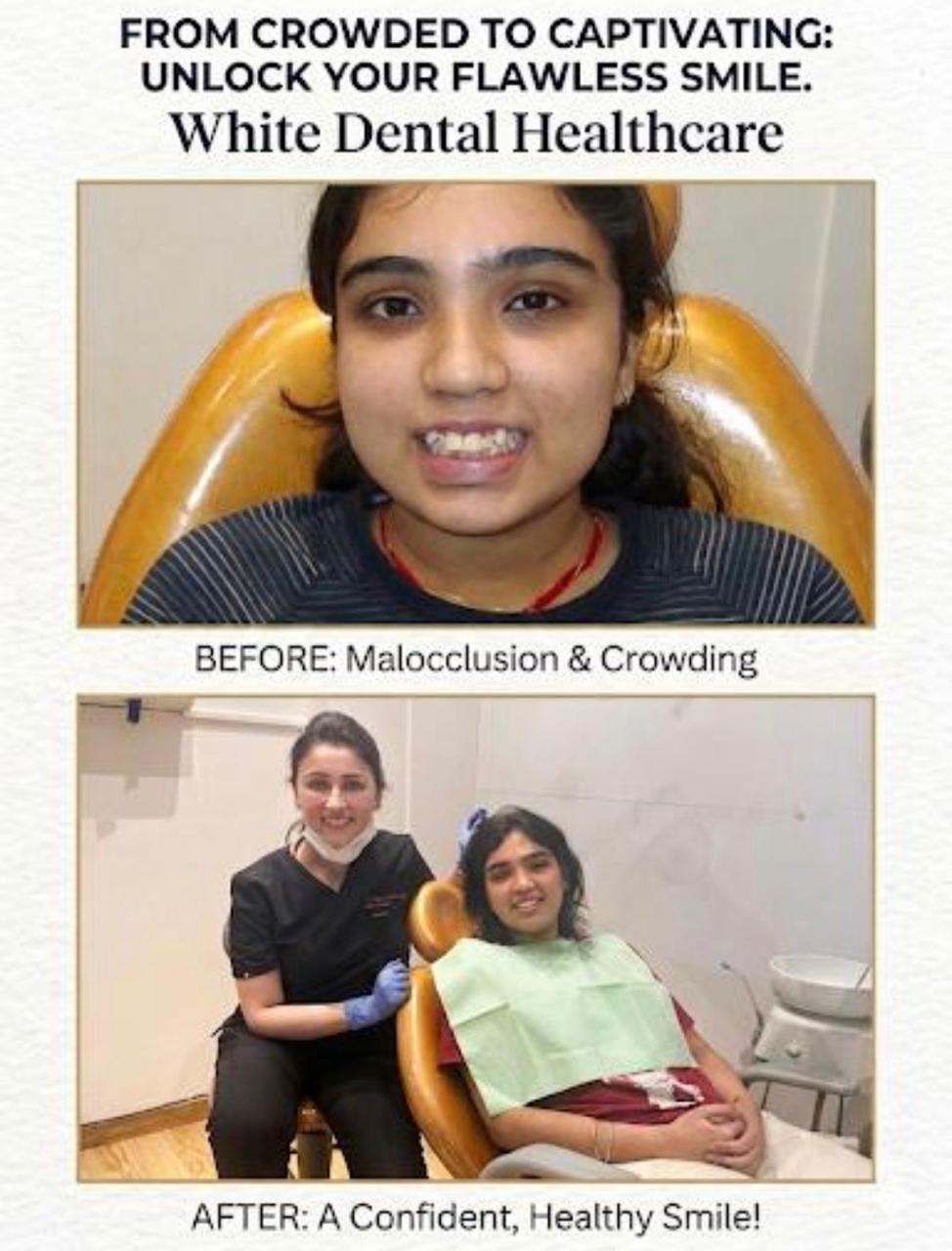 Adult braces before and after transformation — orthodontic patient at White Dental Healthcare, Indirapuram