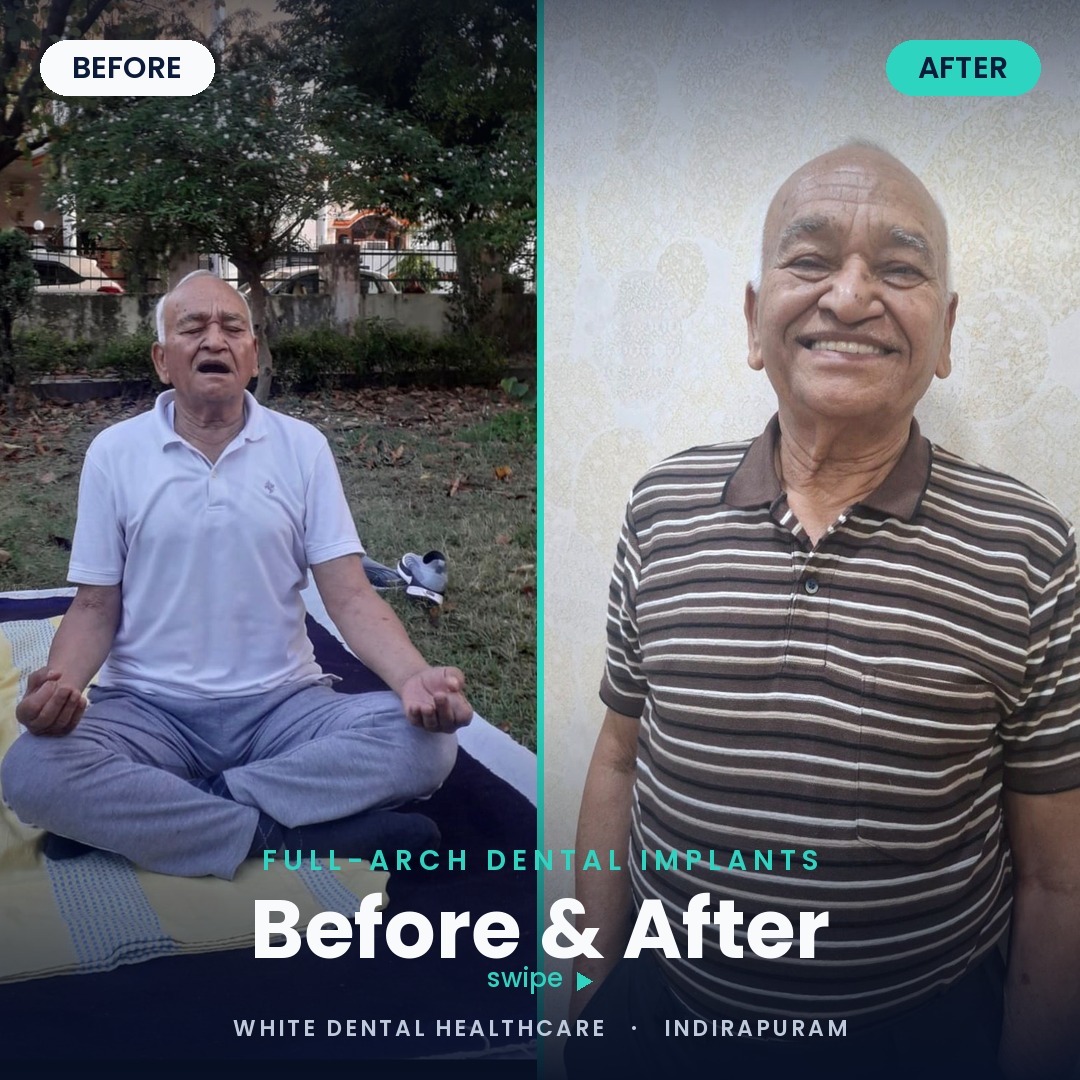 Full-mouth implant rehabilitation before and after at White Dental Healthcare, Indirapuram — made possible by proper bone grafting