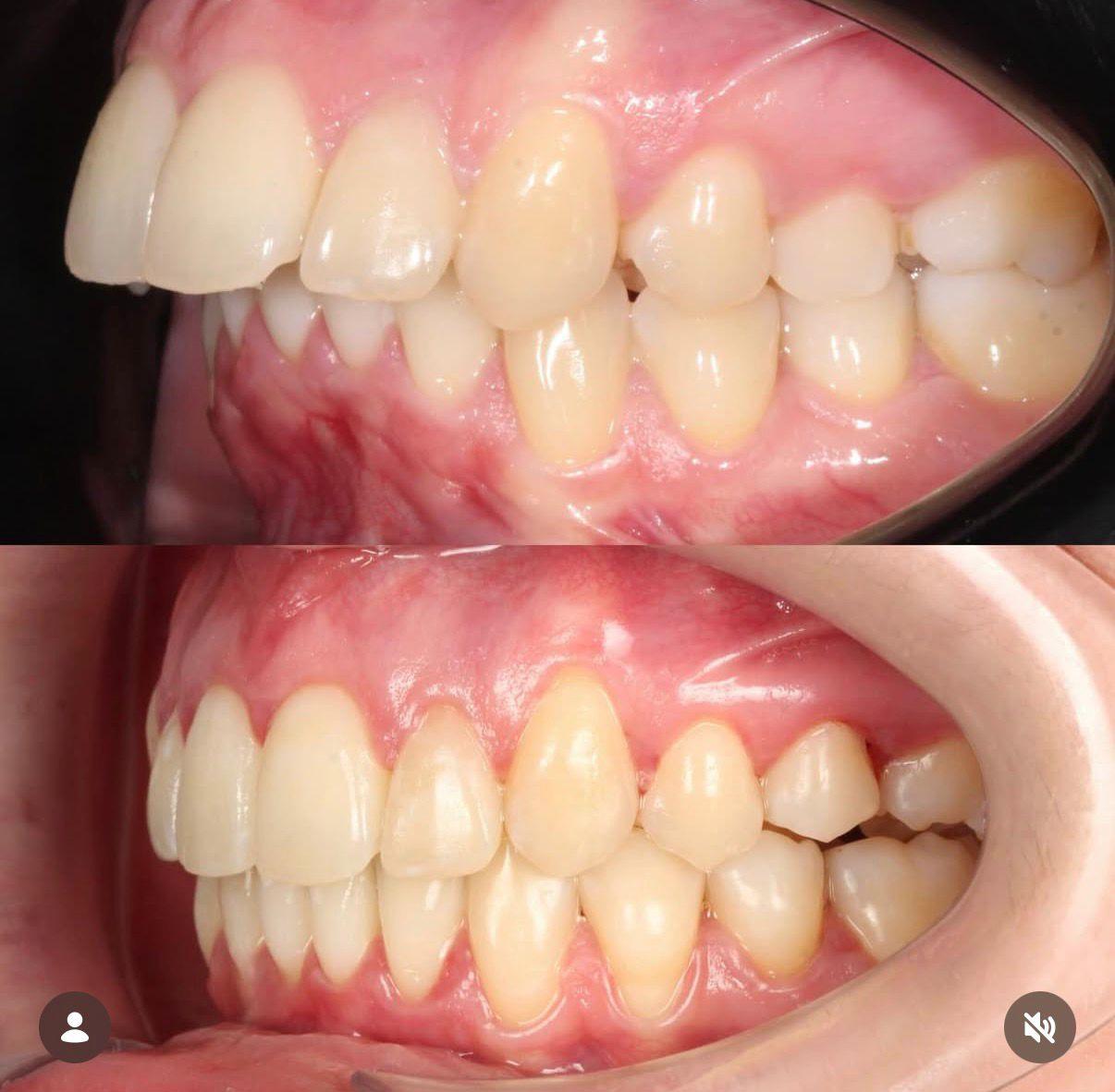 Invisalign clear aligner treatment in Indirapuram by Gold Certified Provider Dr. Devanjali Soin at White Dental Healthcare