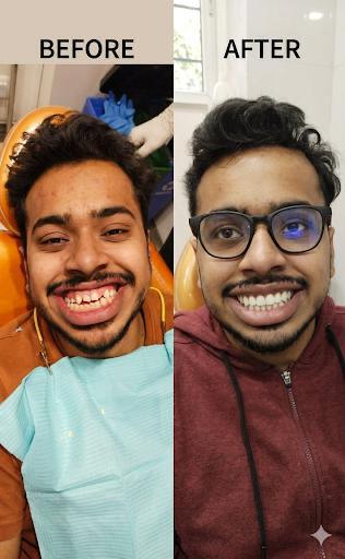 Smile correction before and after at White Dental Healthcare, Indirapuram