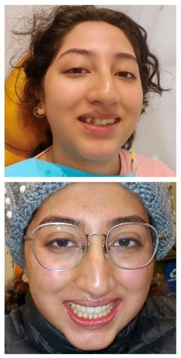 Ceramic Damon clear braces used for overjet correction at White Dental Healthcare, Indirapuram